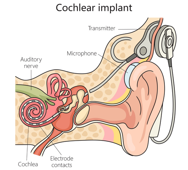 Cochlear Implant