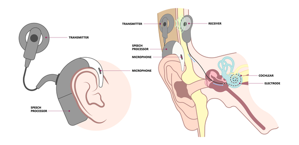 External and internal components of a cochlear implant